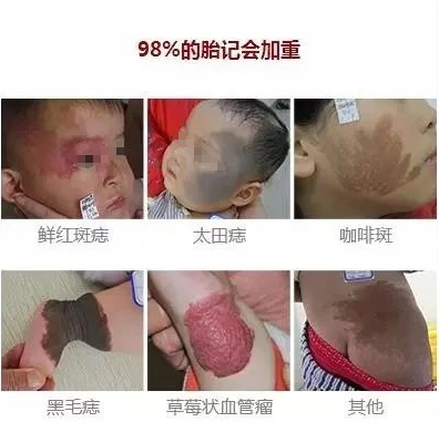 好胎记坏胎记怎么区分宝宝的胎记如果长这样父母一定要重视