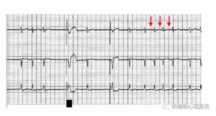 【郭继鸿教授心电系列之三十八】心房颤动性心肌病