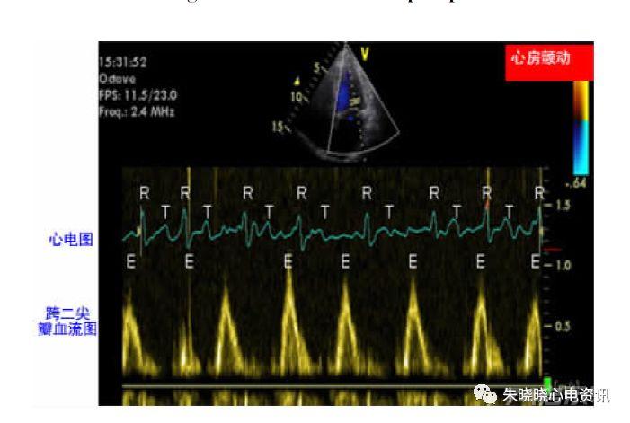 【郭继鸿教授心电系列之三十八】心房颤动性心肌病