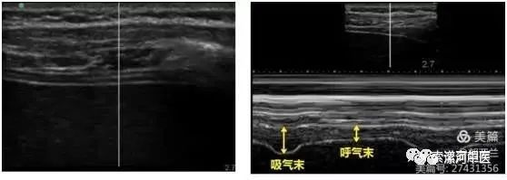 超声评估膈肌功能