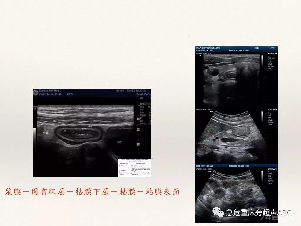 胃肠超声在急危重患者肠内营养中的应用