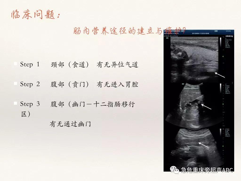 胃肠超声在急危重患者肠内营养中的应用