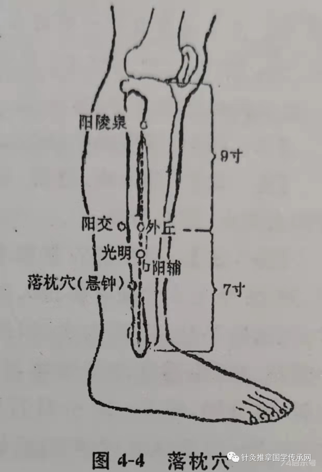 一针疗法 落枕穴