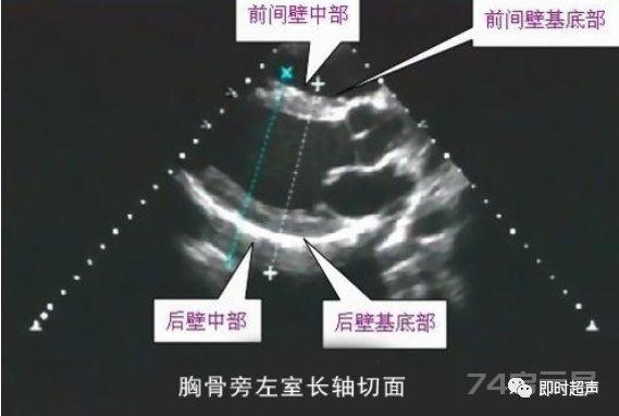 左心室分段的依据、方法与记忆技巧