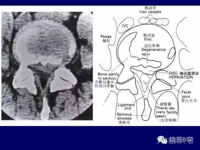 脊柱腰段解剖图（详细标注版 影像图片）