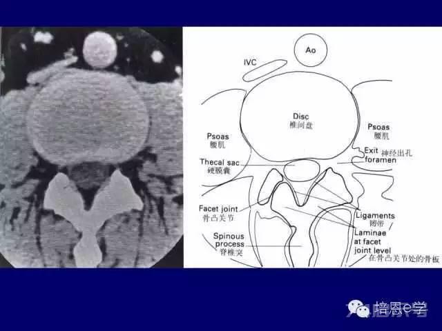 脊柱腰段解剖图（详细标注版 影像图片）