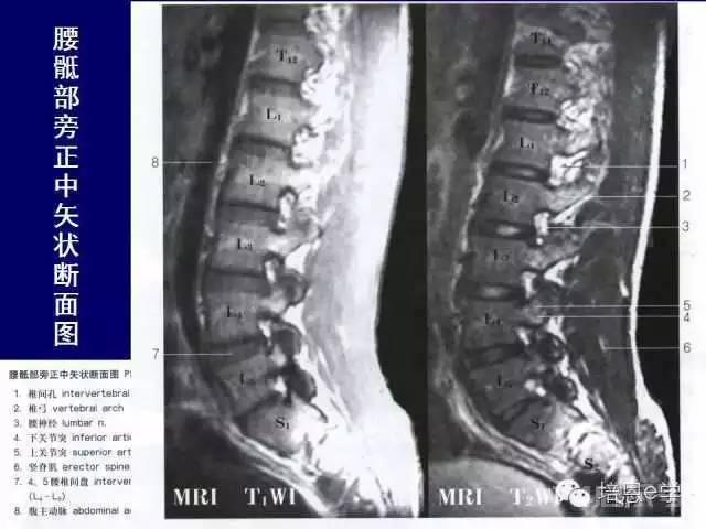 脊柱腰段解剖图（详细标注版 影像图片）