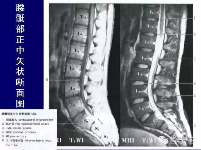 脊柱腰段解剖图（详细标注版 影像图片）