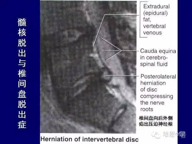 脊柱腰段解剖图（详细标注版 影像图片）