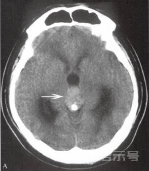 [要点与提醒] “生殖细胞瘤”的诊断要点与特别提醒，附表：松果体区肿瘤的CT鉴别要点