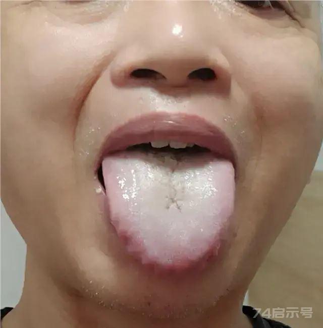 痰多，吐不完？中医通过舌象教你4个中成药，挖走你的老痰