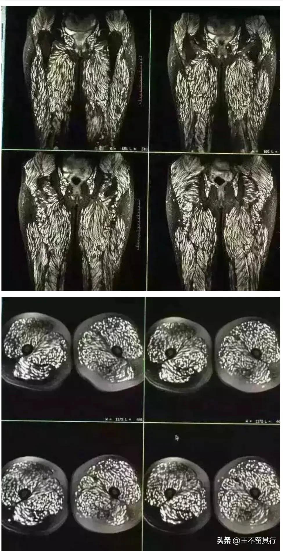 肺吸虫病的症状图片图片