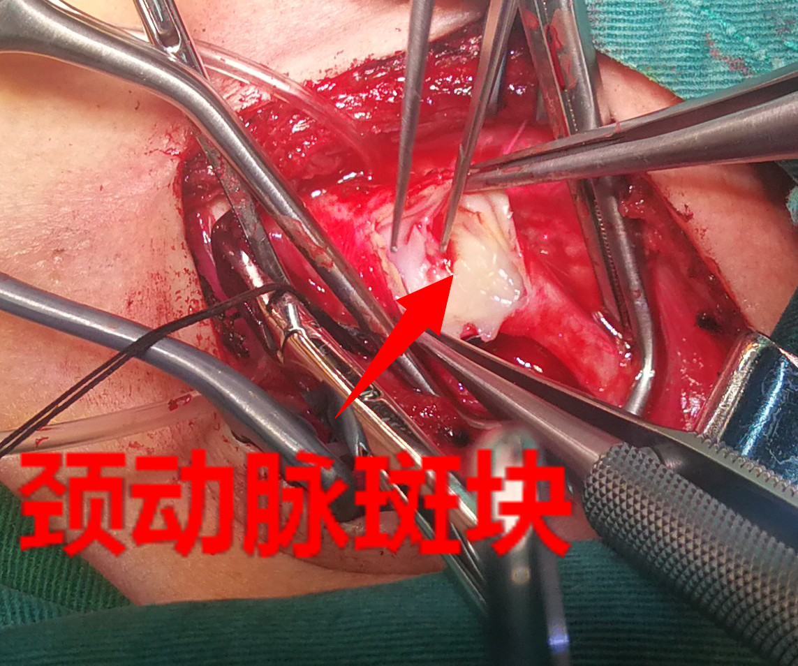 如何做到让心肌不缺血_心肌下壁缺血严重吗_一次性心肌缺血