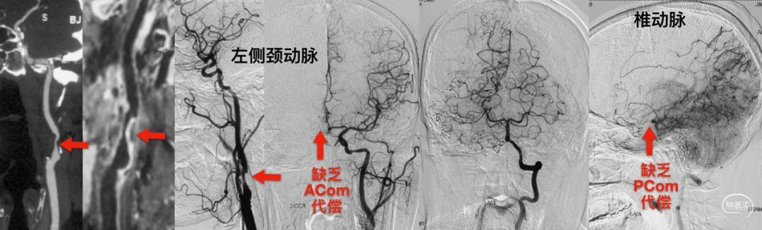 心肌下壁缺血严重吗_一次性心肌缺血_如何做到让心肌不缺血