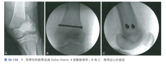 股骨干骨折_股骨干骨折新进展_股骨干骨折的特有体征
