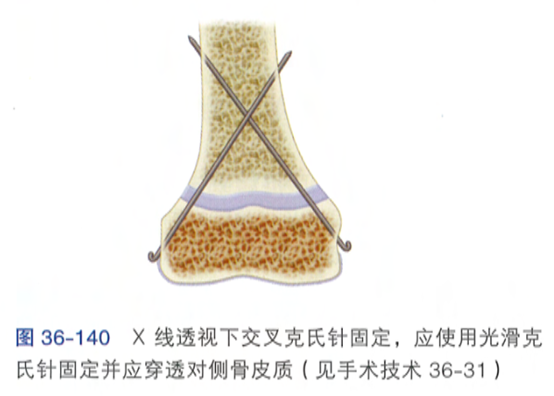 股骨干骨折的特有体征_股骨干骨折新进展_股骨干骨折