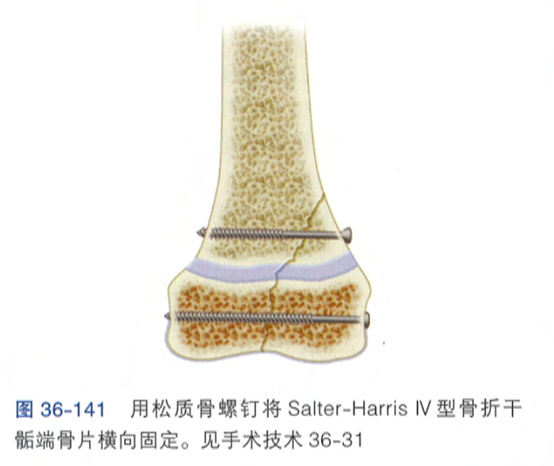 股骨干骨折的特有体征_股骨干骨折_股骨干骨折新进展