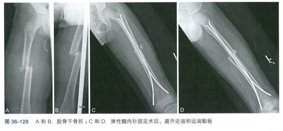 股骨干骨折的特有体征_股骨干骨折新进展_股骨干骨折