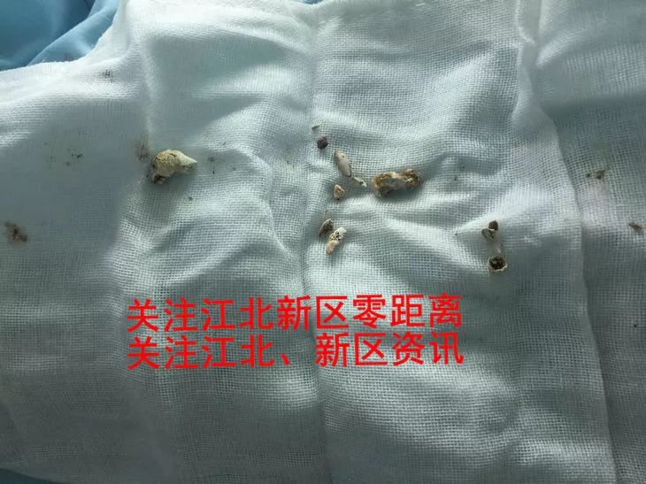管胰腺炎的药_胰管_管胰腺的药