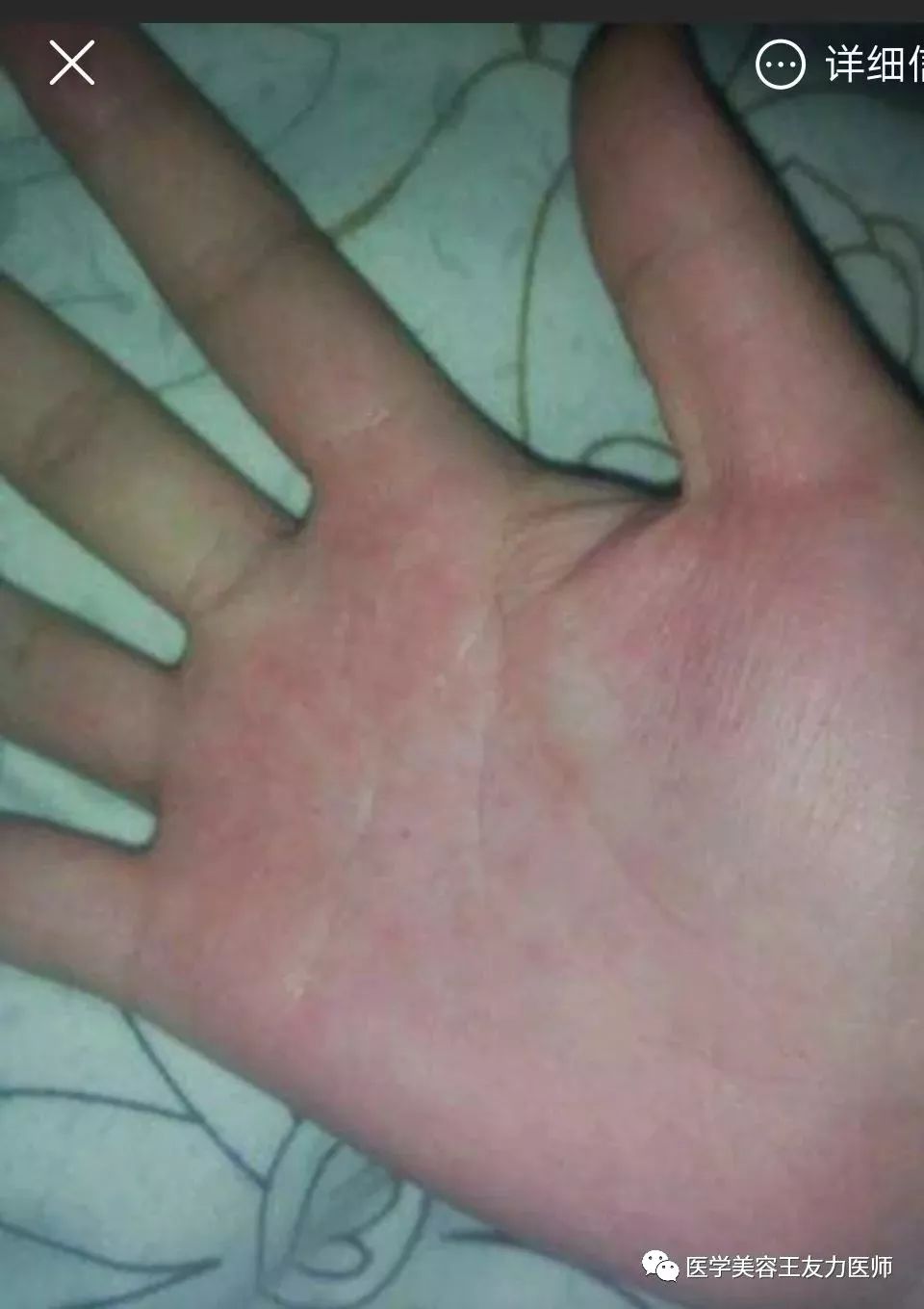 手脱皮_脱皮手膜真的有用吗_脱皮手裂脚裂用什么药膏好