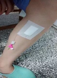 浮针的禁忌症和注意事项