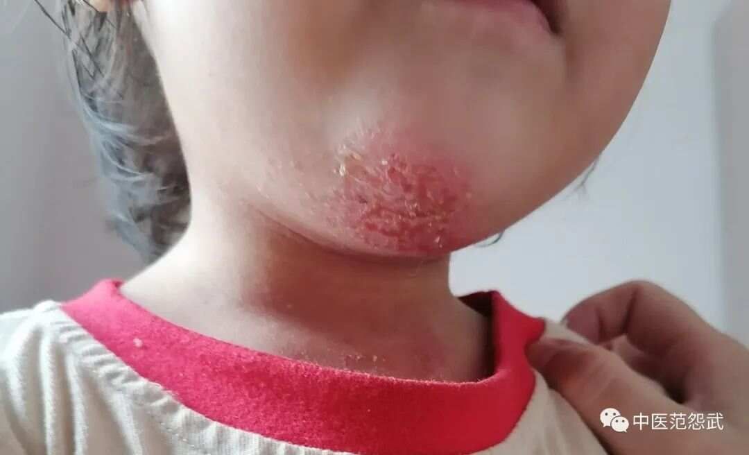 灸治特应性皮炎
