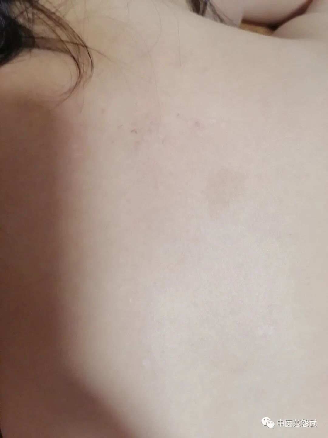灸治特应性皮炎