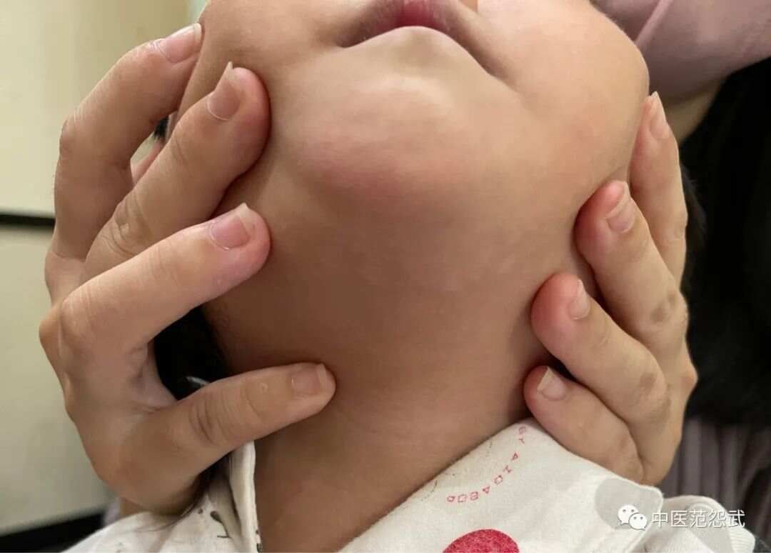 灸治特应性皮炎
