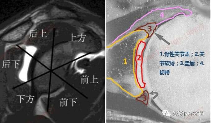 影像综述关于肩关节运动损伤：盂唇与盂肱韧带的影像表现（上）