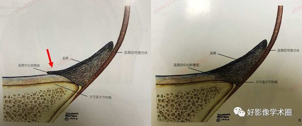 影像综述关于肩关节运动损伤：盂唇与盂肱韧带的影像表现（上）