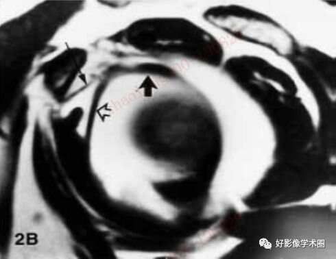 影像综述关于肩关节运动损伤：盂唇与盂肱韧带的影像表现（上）