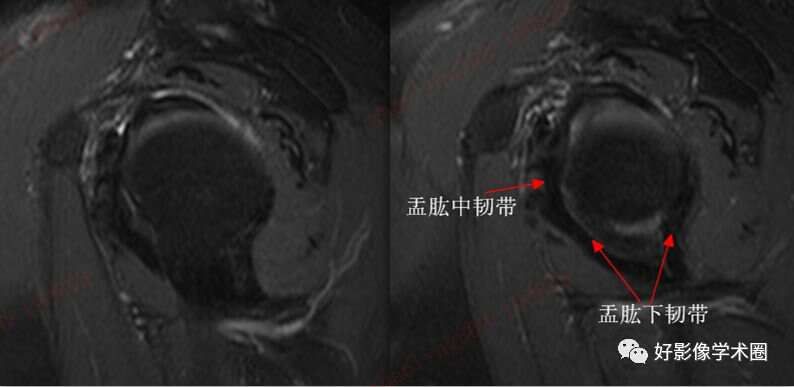 影像综述关于肩关节运动损伤：盂唇与盂肱韧带的影像表现（上）