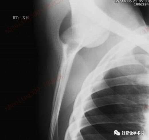 影像综述关于肩关节运动损伤：盂唇与盂肱韧带的影像表现（上）