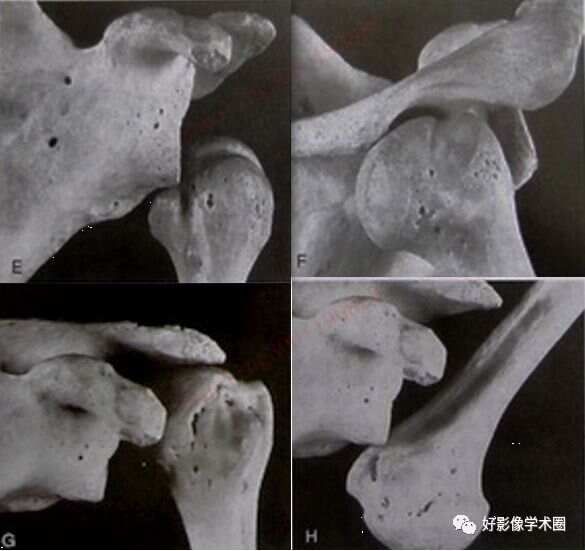 影像综述关于肩关节运动损伤：盂唇与盂肱韧带的影像表现（上）