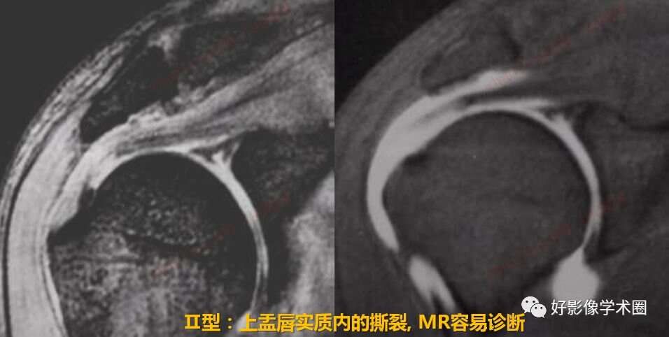 影像综述关于肩关节运动损伤：盂唇与盂肱韧带的影像表现（上）
