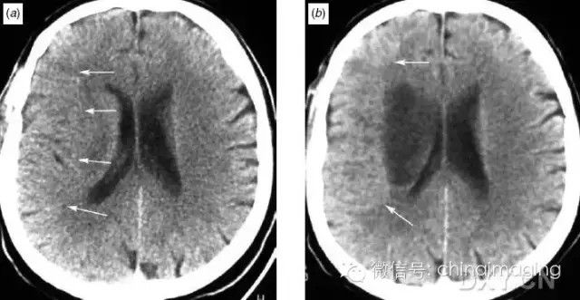 图文详解缺血性脑卒中早期CT表现