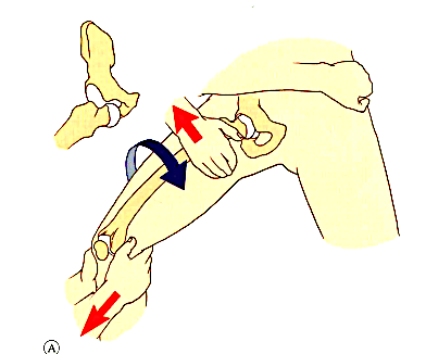 急性髋关节脱位的手法复位，这样「抱大腿」没毛病！