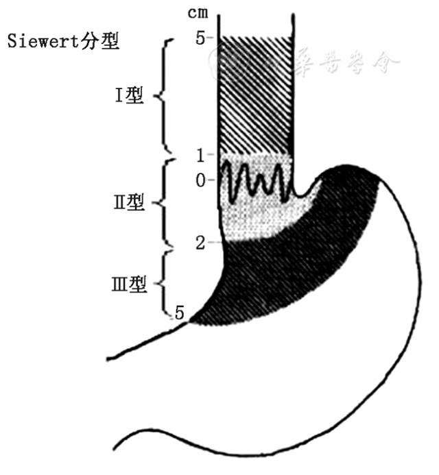 564胃食管反流病、Barrett食管和食管胃交界腺癌病理诊断共识