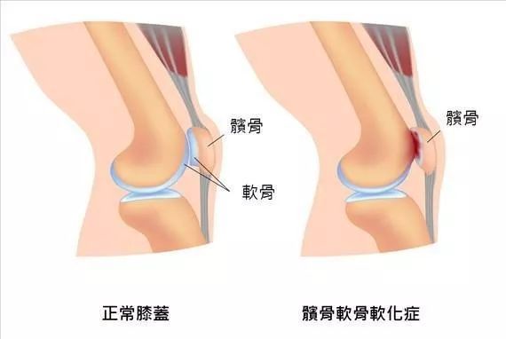 髌骨软化症的影像诊断