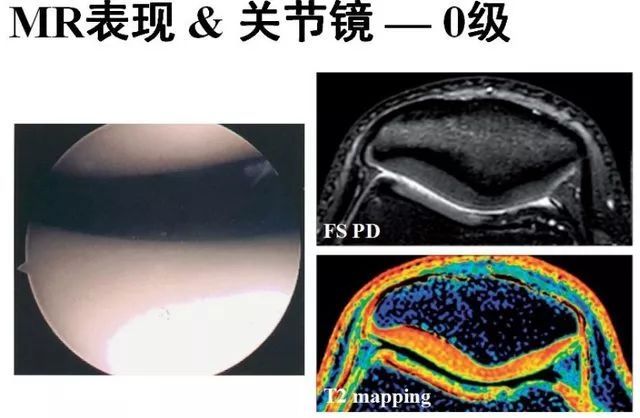 髌骨软化症的影像诊断