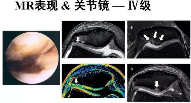 髌骨软化症的影像诊断