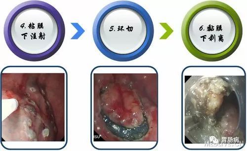 内镜粘膜下剥离术（ESD）