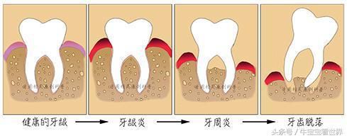 牙周专科博士谈牙周炎，每个人都应该知道的牙周炎
