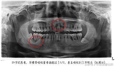 牙周专科博士谈牙周炎，每个人都应该知道的牙周炎