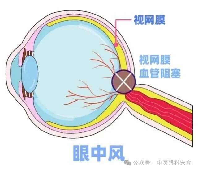 视物不清眼底血管瘀堵，教你一个小妙招，分清6种血瘀，看看你是哪