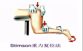常见关节脱位及手法整复——绝对实用！