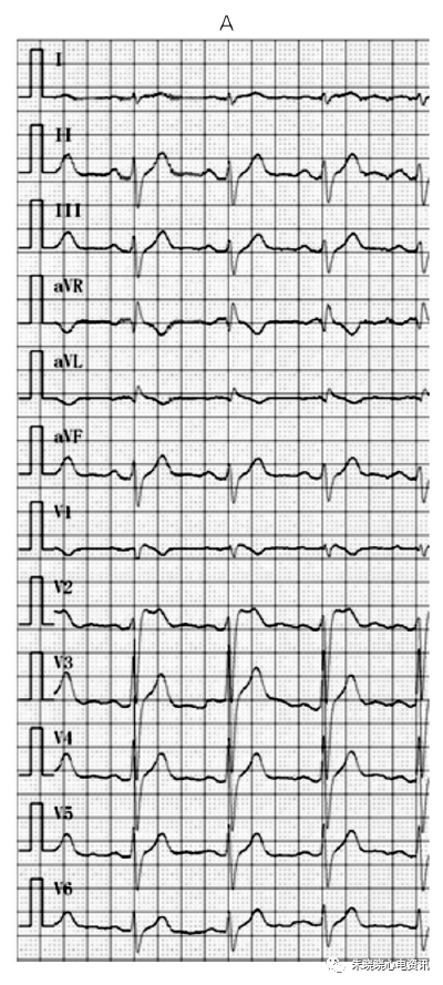 典型 Brugada 综合征伴明显下壁导联心电图动态变化