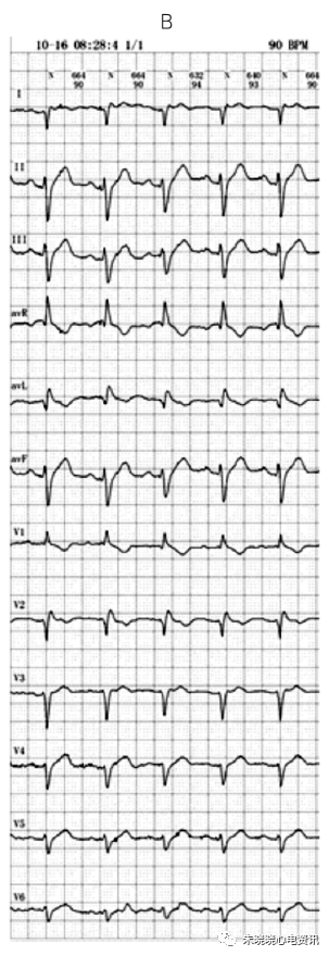 典型 Brugada 综合征伴明显下壁导联心电图动态变化