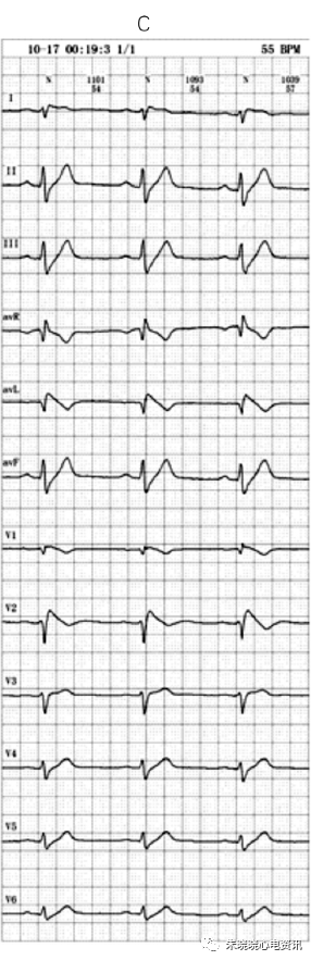 典型 Brugada 综合征伴明显下壁导联心电图动态变化