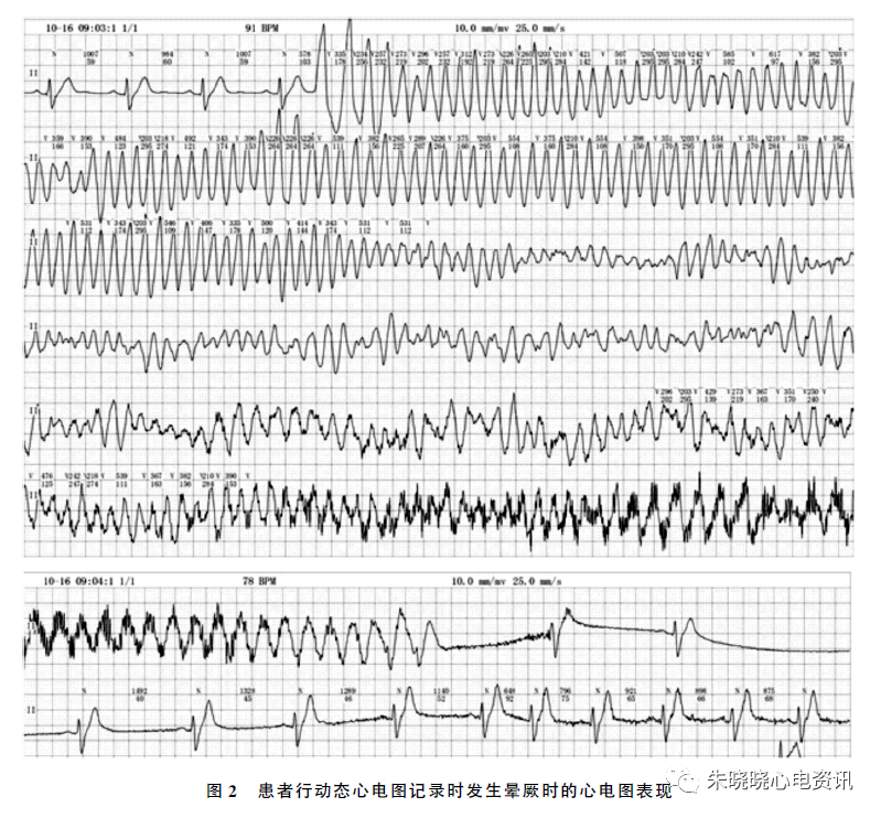 典型 Brugada 综合征伴明显下壁导联心电图动态变化